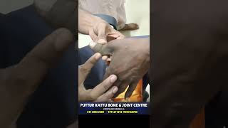 Thumb Finger Joint Dislocation  கட்டைவிரல் மூட்டு விலகல் சிகிச்சை  DrRSVelumani  Putturkattu [upl. by Nosretep968]