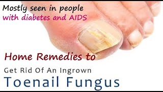 Home Remedies for Ingrown Toenail I How to Treat an Ingrown Toenail I How to Get Rid of Ingrown Toe [upl. by Cort639]