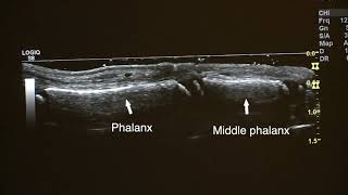 Ultralydundersøkelse av barn 2 proksimale interfalangealledd PIP2 longitudinal dorsal scan [upl. by Stanway]