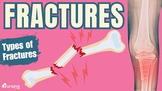 Bone Fractures Types of Fractures Nursing [upl. by Giah]