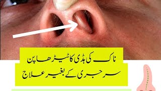 Deviated nasal septum treatment without surgery  DNS  Homeopathy [upl. by Anirehs]