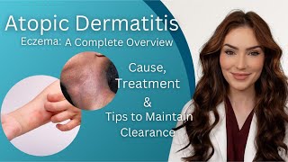 Atopic Dermatitis  Diagnosis Treatment and Maintenance Tips [upl. by Rushing398]