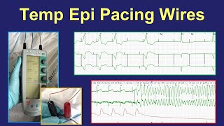 Surgical epicardial pacing wires  uses and management [upl. by Jo-Anne271]