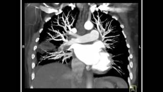 Lung Anatomy Pulmonary Emboli amp Infarcts VRT 3 of 4 [upl. by Onileva]