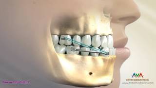 Orthodontic Treatment for Underbite or Crossbite  Carriere Appliance [upl. by Ruthann]