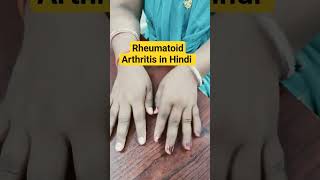 Rheumatoid Arthritis in Hindi  Dr Sai Chandra MBBS DNB Ortho [upl. by Ecnadnak783]