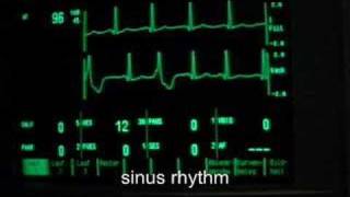 extrasystoles ventricular bigeminus [upl. by Crandale639]