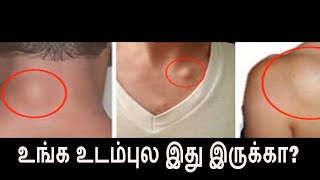 உங்க உடம்புல இது இருக்கா  Lipoma health tips Tamil [upl. by Los]