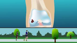 Using osteochondral allograft transplantation to treat articular cartila [upl. by Lotty656]