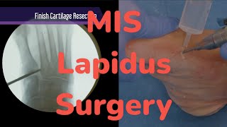 MIS Lapidus Surgery [upl. by Yllac666]