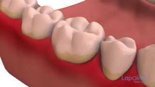 Dental plaque  Lapointe dental centres [upl. by Roehm753]