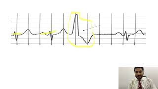 Mastering ECGLesson17 PVCs amp PACs  premature ventricular amp atrial contractions [upl. by Weihs978]