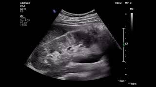 Acute pyelonephritis ultrasound patient with flank pain fever ARDMS sonography [upl. by Ronoh]