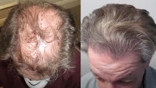 No Shave FUE Hair Transplant Testimonial [upl. by Maghutte]