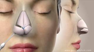 Rhinoplasty Nose Job Video Animation  Guncel Ozturk MD  DRGO [upl. by Romie815]