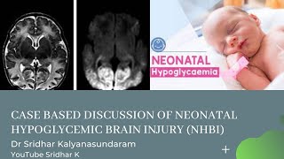 Case based discussion of neonatal hypoglycemic brain injury Neonatal hypoglycemia Dr Sridhar K [upl. by Savil]