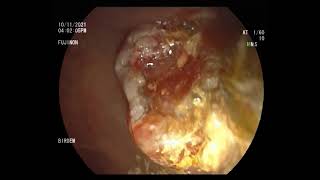 choledocholithiasis with cholangitis stone extraction [upl. by Cyrille]