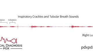 The Lung Sounds of Pneumonia [upl. by Tildy477]