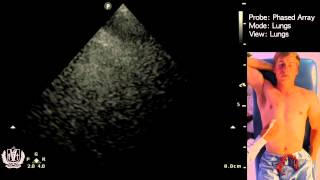 Evaluating the Lungs using Ultrasound [upl. by Trant]