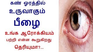 What is that crusty particle your eyes corner in Tamil  Rahul Eye Health tips in tamil [upl. by Adnauqahs]