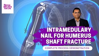 Intramedullary Nail For Humerus Shaft Fracture Procedure [upl. by Nolla]