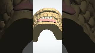 Lower Flexible Denture dentalclinic [upl. by Leorsiy]