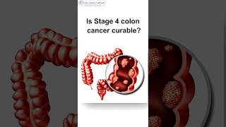 Is Stage 4 Colon Cancer Curable cancer [upl. by Grory65]