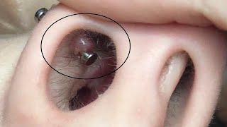 how to get rid of nose piercing bump inside your nose tutorial [upl. by Dlonyar151]