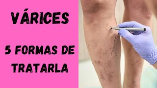 ¡Cuidado con las Varices 5 Formas de Evitar la Cirugía [upl. by Akiner]