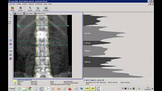 Demonstração de análise de exames de densitometria óssea utilizando software Encore GELunar [upl. by Sternlight220]
