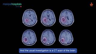 Stroke  Dr Amit Dhakoji  Manipal Hospital Baner [upl. by Damien]