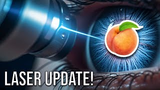 LASER Surgery Update  Hemorrhoids Anal Fistula Pilonidal Cyst [upl. by Adi842]