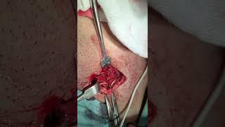 Femoral Hernia Repair Lotheissens operation inguinal approach [upl. by Kassel]