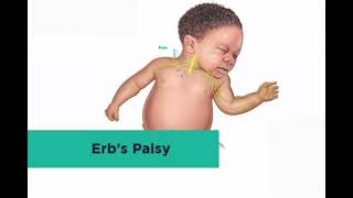 ERBS palsy mrcpch Video station [upl. by Arlin]