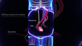 Kidney Stone In The Ureter shorts education [upl. by Pyne]