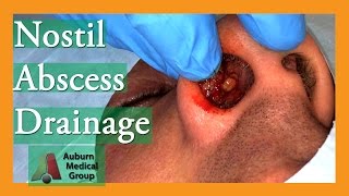 Nostril Abscess Drainage  Auburn Medical Group [upl. by Tnecnev]