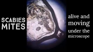 Scabies  moving around on mineral oil skin scraping preparation [upl. by Tillie531]