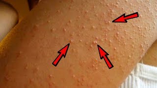 Natural Treatment to Get Rid of Keratosis Pilaris Chicken Skin [upl. by Ydaf449]