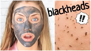 SKIN GRITTING  CRAZY Blackhead Removal Method [upl. by Anomahs]