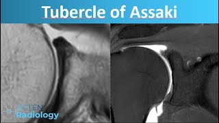 Glenoid variant or pathology  Assakis tubercle [upl. by Tommie]