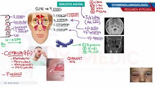 Otorrinolaringología  Sinusitis aguda [upl. by Anairuy536]