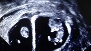 10 WEEKS TWIN PREGNANCY SCAN [upl. by Markman]