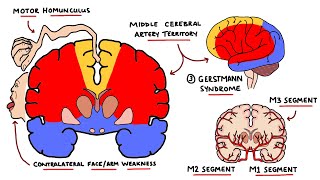 Middle Cerebral Artery Stroke Syndromes  MCA Stroke Syndromes With Gerstmann Syndrome amp Lesions [upl. by Suraved]