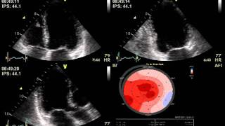 DOBUTAMINE STRESS ECHO MITRAL REGURGITATION  ECHOCARDIOGRAPHY cardiac ultrasound [upl. by Enileda832]