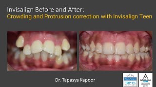 Invisalign Before and After Crowding and Protrusion correction with Invisalign Teen [upl. by Monafo]