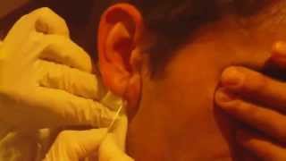 EXTRACTION DUN ENORME BOUTON DE PUS INFECTE DANS LOREILLE MEDICAL VIDEO [upl. by Gifferd]