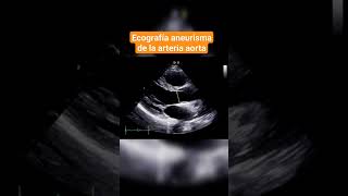 ANEURISMA DE LA ARTERIA AORTA ECOGRAFÍA ABDOMINAL [upl. by Yarak]