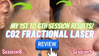 My 1st to 6th Session Results with Co2 Fractional Laser Treatment for my Acne Scars  Before After [upl. by Ahcrop]