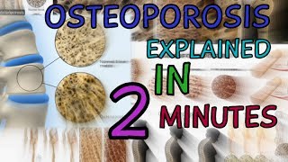 OSTEOPOROSIS  EXPLAINED IN 2 MINUTES  CAUSES  SYMPTOMS  TREATMENT  WHAT IS OSTEOPOROSIS [upl. by Cottle]