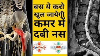 बस ये करो ठीक हो जाएगी कमर में दबी नस  L4L5 disc Bulge  SCIATICA  DABI NAS  leg pain  Hip pain [upl. by Courtland]